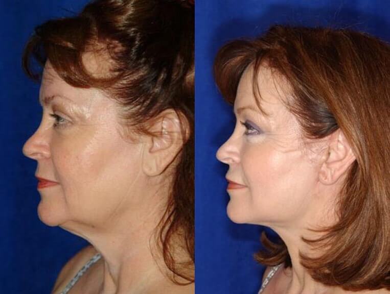 Facelift Before And After Patient 15 Case 3553 Left View