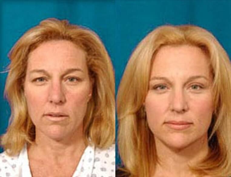 Facelift Before And After Patient 16 Case 3559 Front View