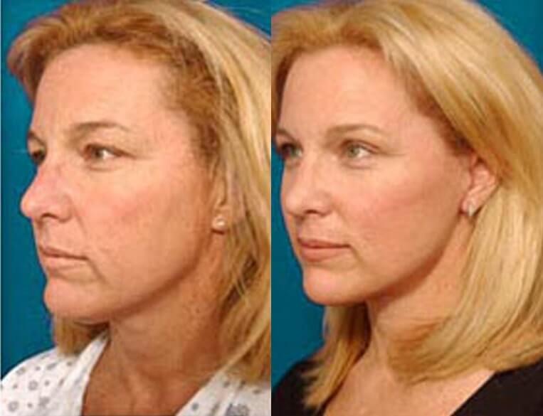Facelift Before And After Patient 16 Case 3559 Left View