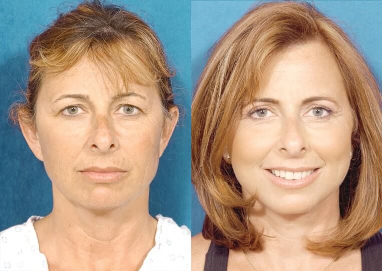 Facelift Before And After Patient 17 Case 3565 Front View