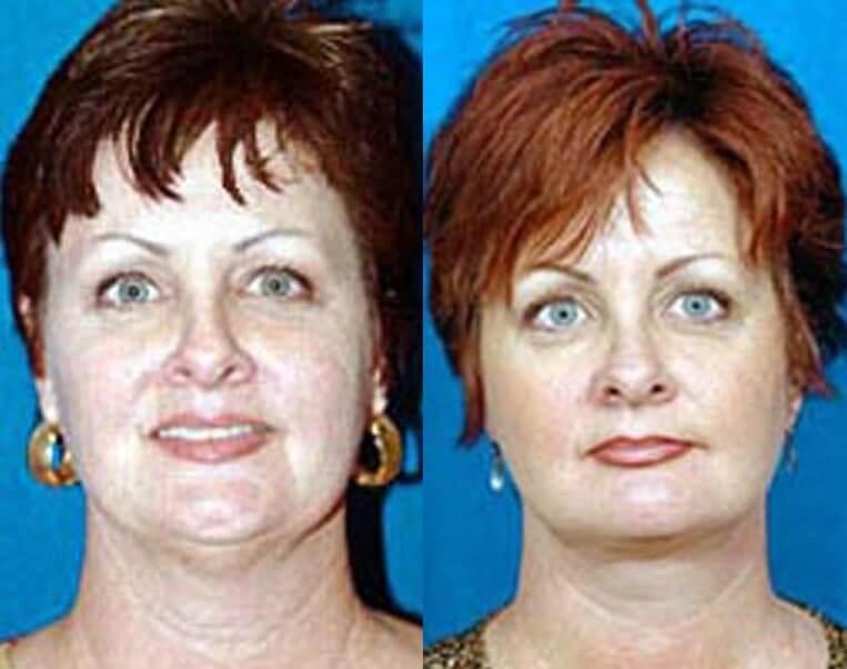 Facelift Before And After Patient 18 Case 3573 Front View