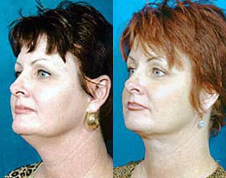 Facelift Before And After Patient 18 Case 3573 Left View