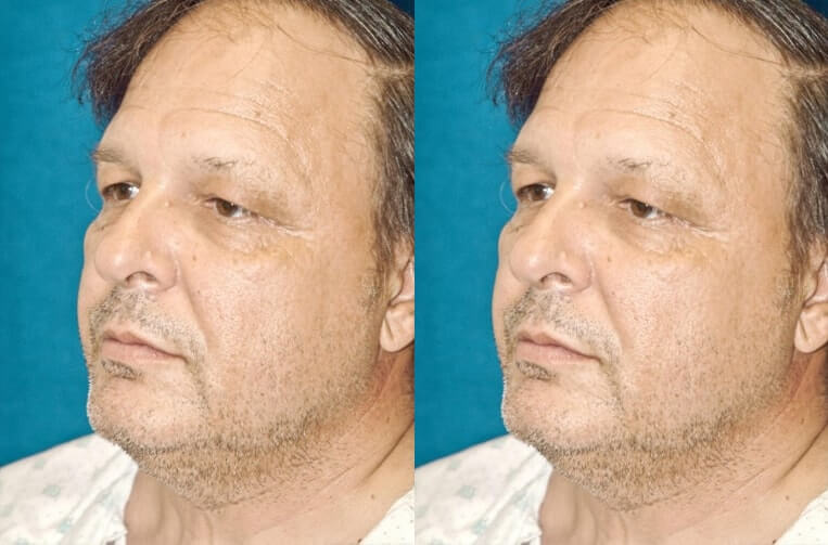 Facelift Before And After Patient 19 Case 3585 Left View