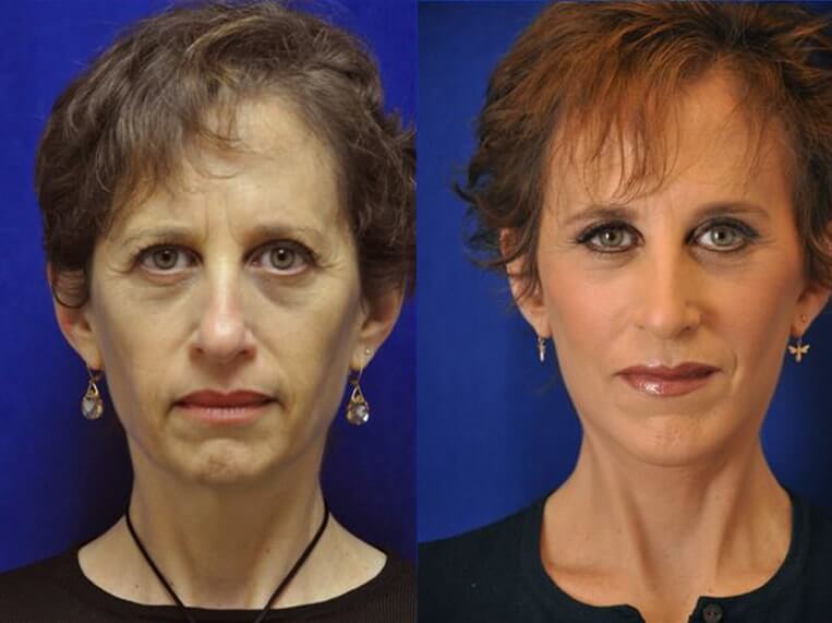 Facelift Before And After Patient 20 Case 3591 Front View