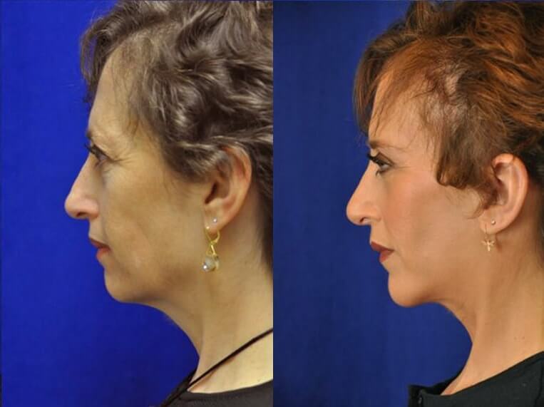 Facelift Before And After Patient 20 Case 3591 Left View