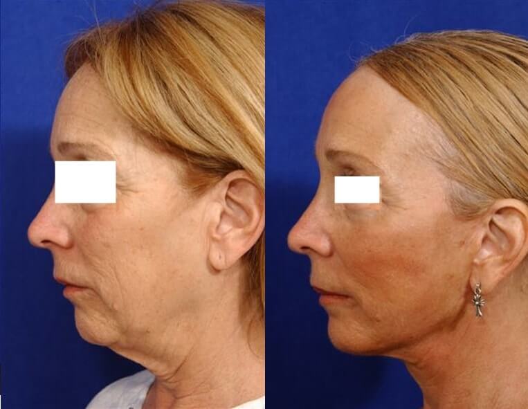 Facelift Before And After Patient 21 Case 3597 Left View