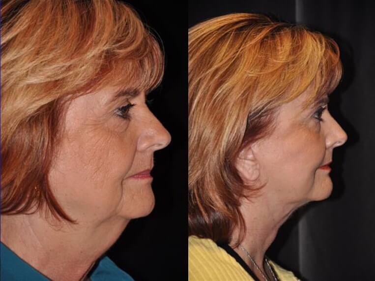 Facelift with Necklace and Upper Blepharoplasty