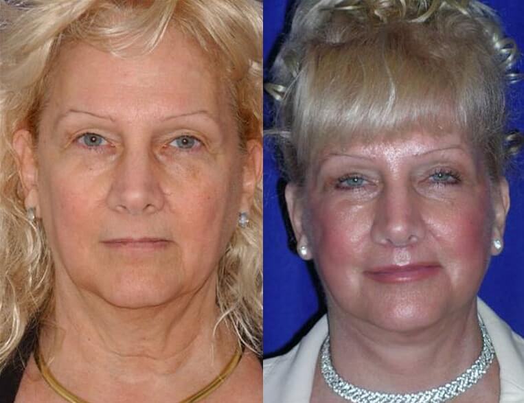 Facelift Before And After Patient 23 Case 3605 Front View