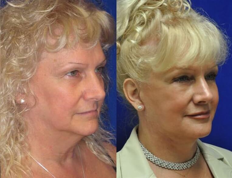 Facelift Before And After Patient 23 Case 3605 Right View