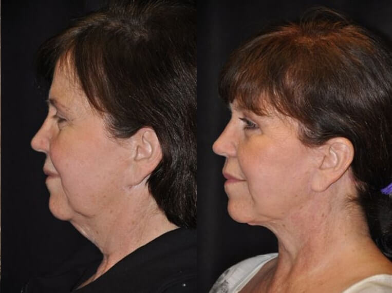 Facelift with Necklace, Earlobe Revision, Livefill to Lips, USIC Cheeklift, Upper Blepharoplasty