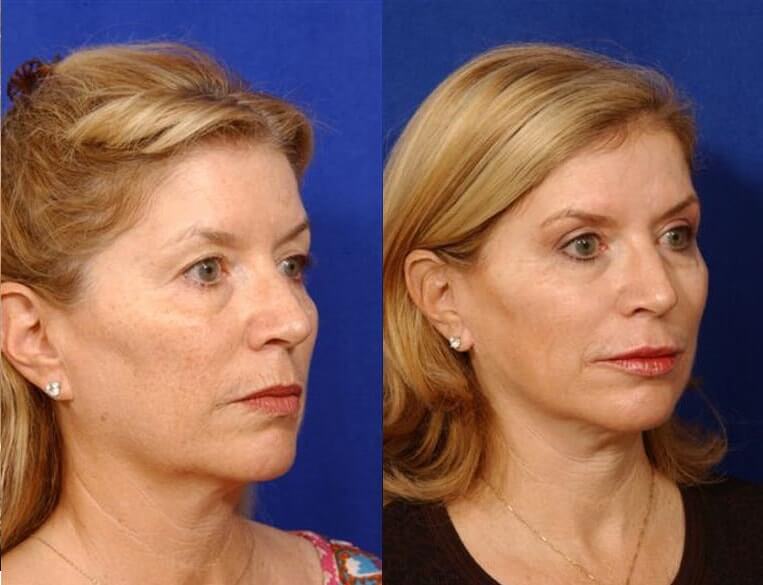 Facelift Before And After Patient 25 Case 3619 Right View