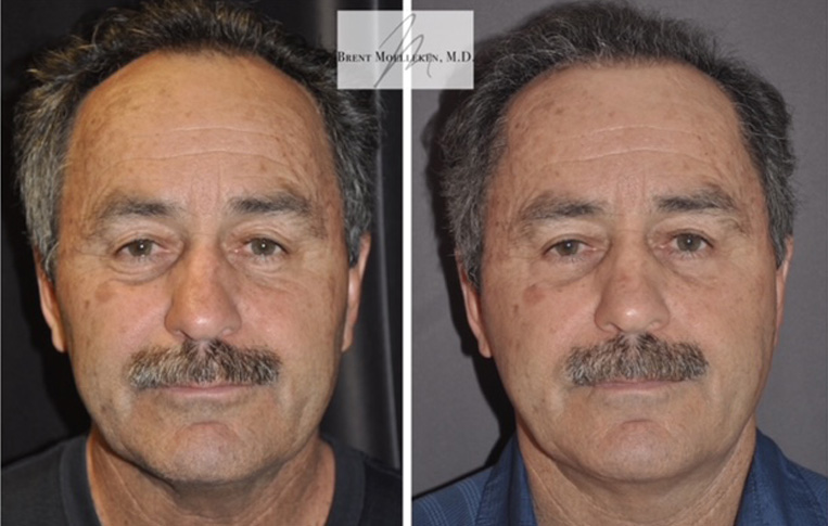 Facelift with Necklace, Upper Blepharoplasty, Livefill to Glabella, Lateral Browlift