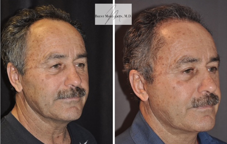 Facelift with Necklace, Upper Blepharoplasty, Livefill to Glabella, Lateral Browlift