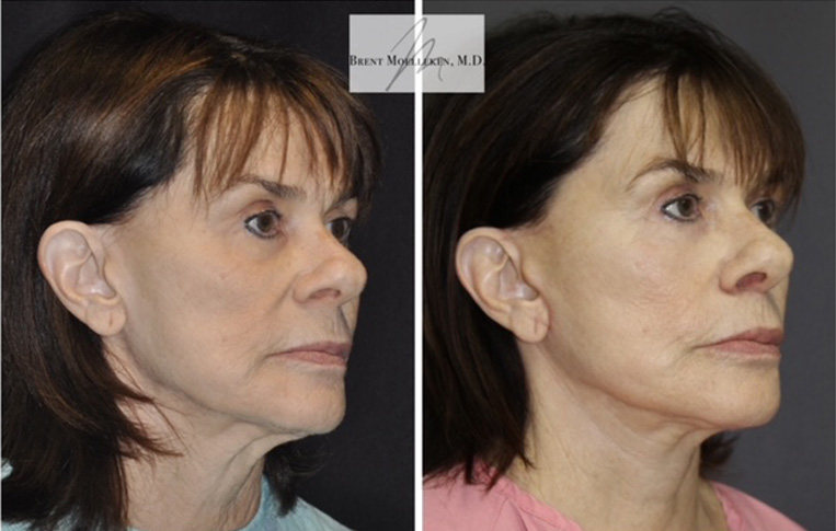 Facelift with Necklace, USIC Cheeklift, Upper Blepharoplasty, Livefill to Lips, Livefill to Cheeks, Gullwing Lip Lift, Co2 Laser to Face