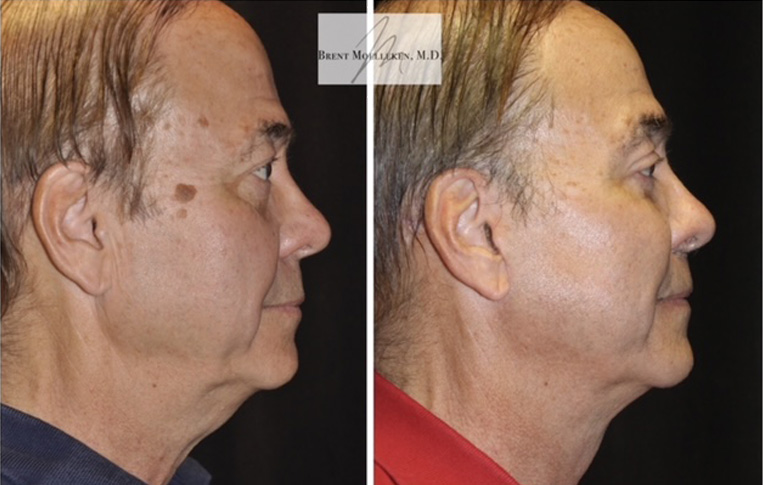 Facelift with Necklace, USIC Cheeklift, Lateral Browlift, Upper Blepharoplasty, Livefill to Frown Lines, Livefill to Nasolabial Folds, Livefill to Lips, Livefill to Cheeks, Gullwing Lip Lift, DAO Release, Co2 Laser to Face