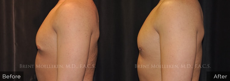 30 yr old male Gynecomastia/ Liposuction to chest Surgery