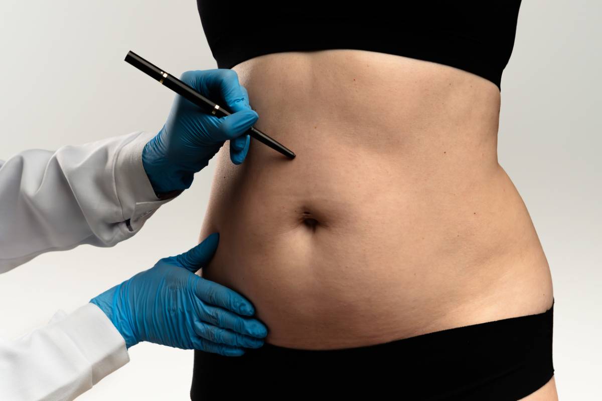 Medical professional drawing surgical lines on patient's abdomen.