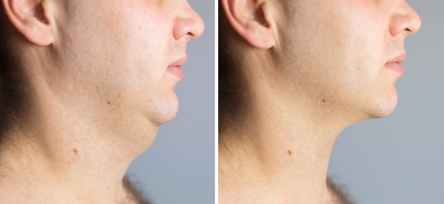 Close-up photo of man before and after double chin fat correction procedure