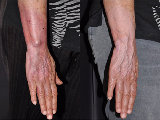 Burns to hand and wrist Post 8 AFT Laser Treatments