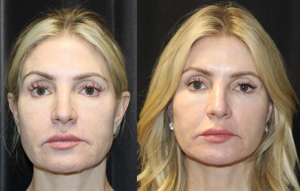 1.Facelift 2. NeckLace platysmaplasty 3. Co2 Laser to face 4.Co2 Laser to neck and chest