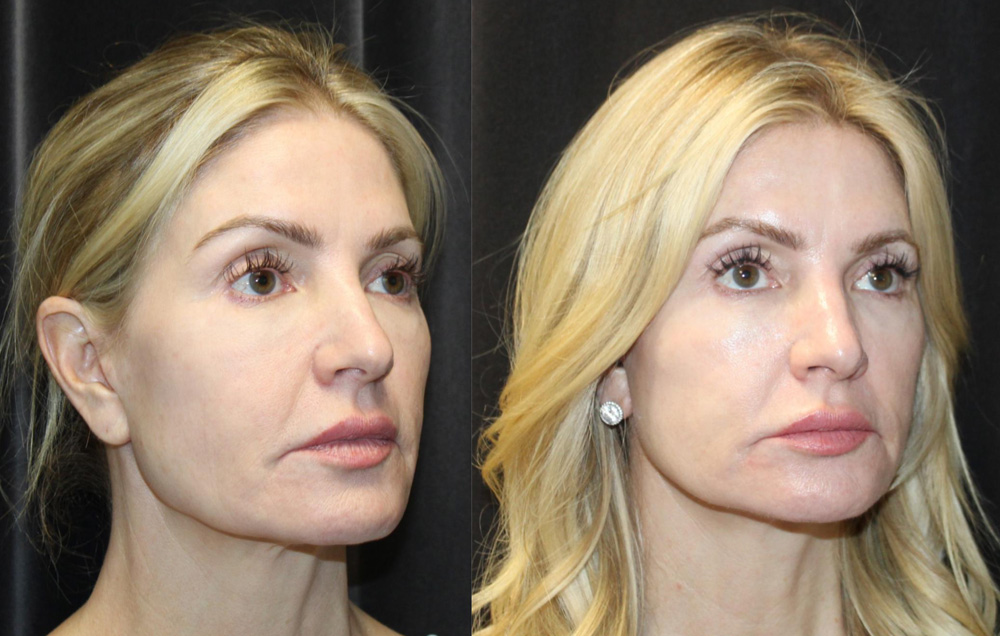 1.Facelift 2. NeckLace platysmaplasty 3. Co2 Laser to face 4.Co2 Laser to neck and chest