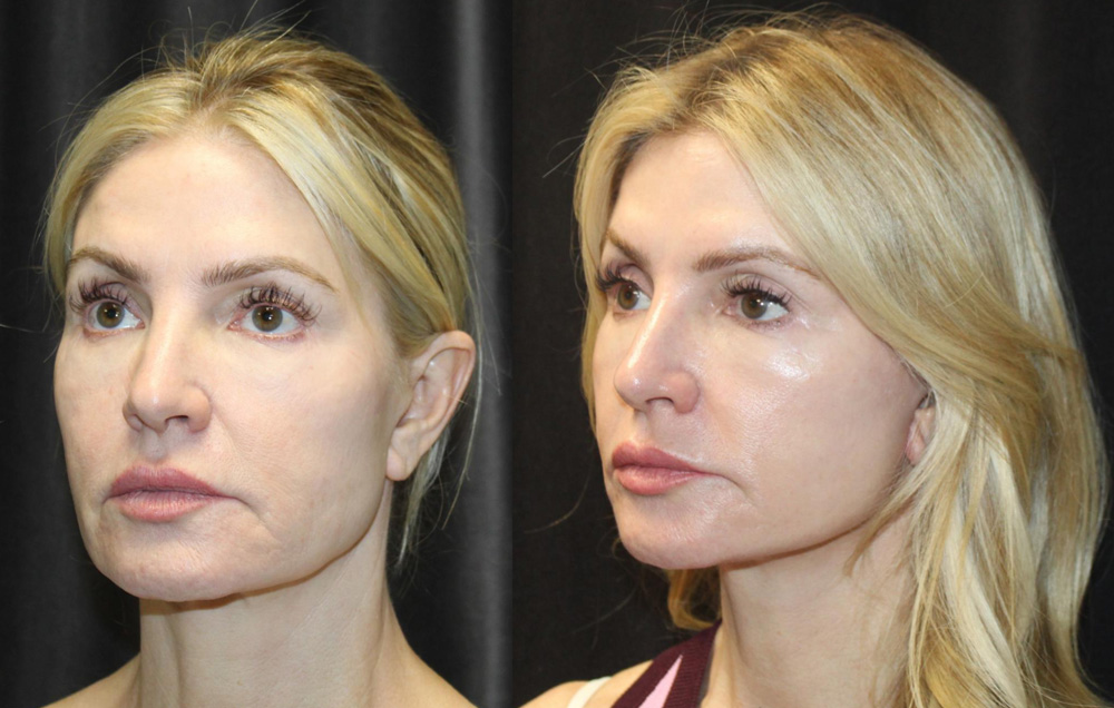 1.Facelift 2. NeckLace platysmaplasty 3. Co2 Laser to face 4.Co2 Laser to neck and chest