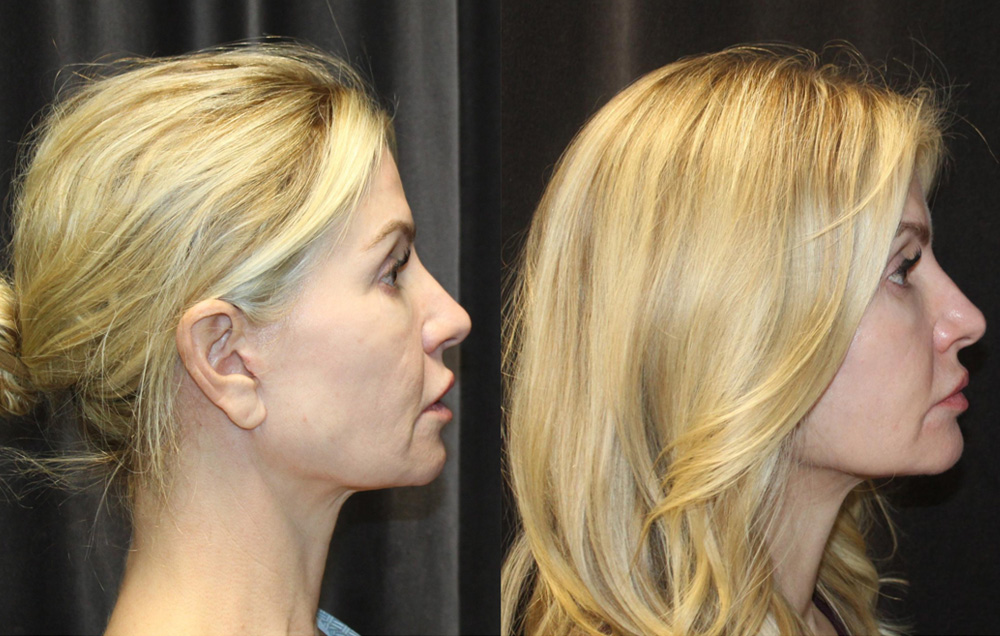 1.Facelift 2. NeckLace platysmaplasty 3. Co2 Laser to face 4.Co2 Laser to neck and chest