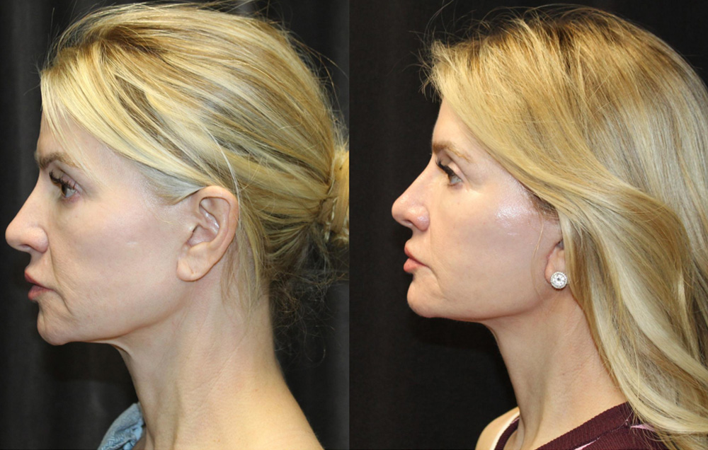 1.Facelift 2. NeckLace platysmaplasty 3. Co2 Laser to face 4.Co2 Laser to neck and chest