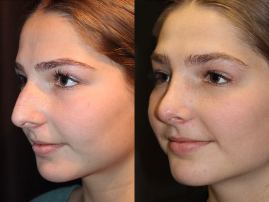 Rhinoplasty before and after 3 1