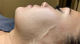 One free Glycolic Peel patent picture