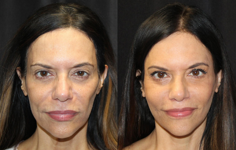 Cervicofacial rhytidectomy, High SMAS technique, 2. Superficial cheeklift, – (USIC), 3. Harvest of fat fascial grafts from lower abdomen, 4. LiveFill to malar eminences, 5. LiveFill to submalar region, 6. LiveFill to temporal hollowing, 7. Lateral brow lift, nerve sparing, 8. Reverse brow lift with galeal scoring bilateral , CO2 laser resurfacing of face