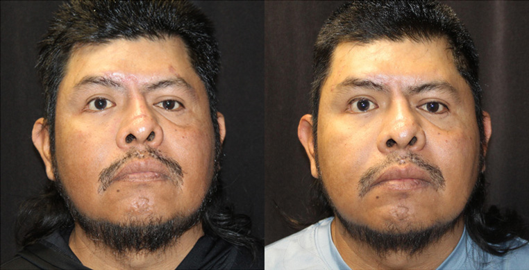facial scarring and nerve damage after an accident, treated with scar repairs, laser, nerve repairs.