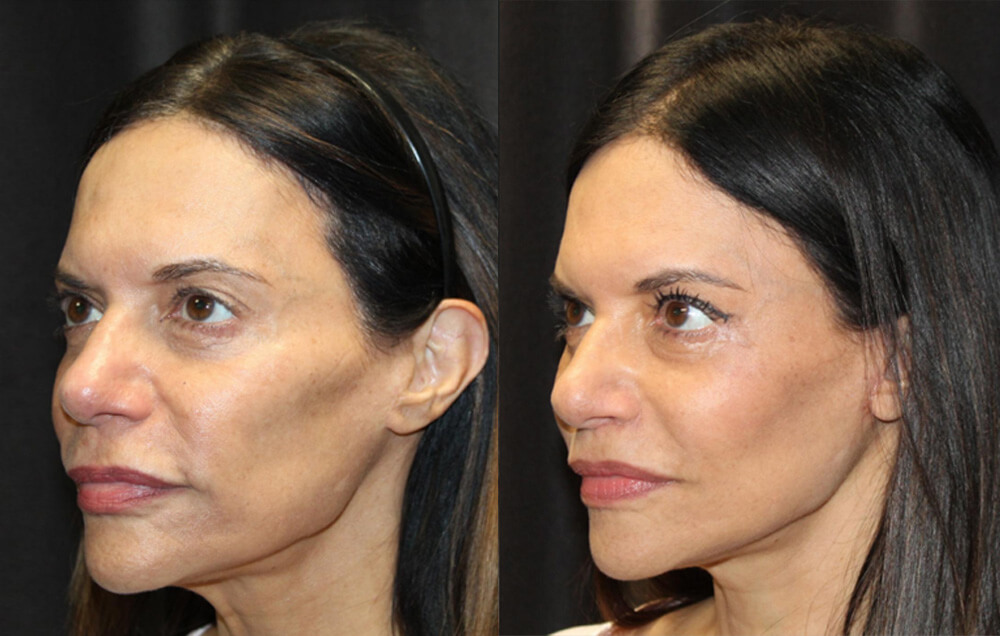 Cervicofacial rhytidectomy, High SMAS technique, 2. Superficial cheeklift, – (USIC), 3. Harvest of fat fascial grafts from lower abdomen, 4. LiveFill to malar eminences, 5. LiveFill to submalar region, 6. LiveFill to temporal hollowing, 7. Lateral brow lift, nerve sparing, 8. Reverse brow lift with galeal scoring bilateral , CO2 laser resurfacing of face