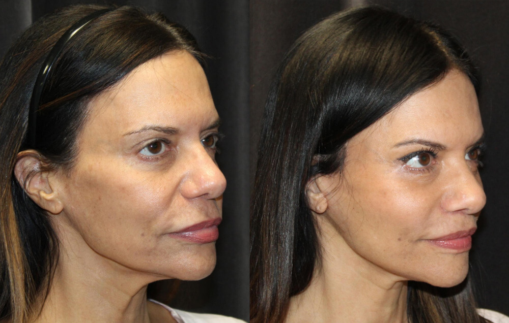 Cervicofacial rhytidectomy, High SMAS technique, 2. Superficial cheeklift, – (USIC), 3. Harvest of fat fascial grafts from lower abdomen, 4. LiveFill to malar eminences, 5. LiveFill to submalar region, 6. LiveFill to temporal hollowing, 7. Lateral brow lift, nerve sparing, 8. Reverse brow lift with galeal scoring bilateral , CO2 laser resurfacing of face