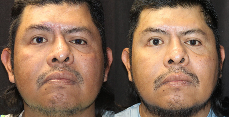 facial scarring and nerve damage after an accident, treated with scar repairs, laser, nerve repairs.