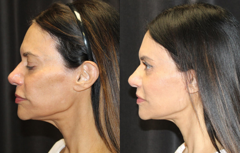 Cervicofacial rhytidectomy, High SMAS technique, 2. Superficial cheeklift, – (USIC), 3. Harvest of fat fascial grafts from lower abdomen, 4. LiveFill to malar eminences, 5. LiveFill to submalar region, 6. LiveFill to temporal hollowing, 7. Lateral brow lift, nerve sparing, 8. Reverse brow lift with galeal scoring bilateral , CO2 laser resurfacing of face