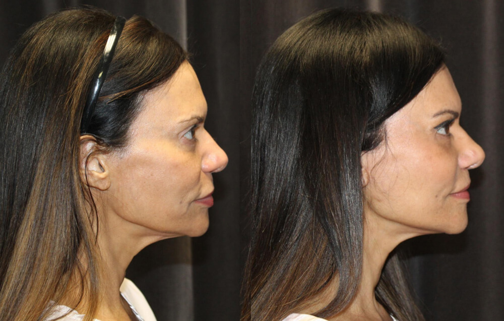 Cervicofacial rhytidectomy, High SMAS technique, 2. Superficial cheeklift, – (USIC), 3. Harvest of fat fascial grafts from lower abdomen, 4. LiveFill to malar eminences, 5. LiveFill to submalar region, 6. LiveFill to temporal hollowing, 7. Lateral brow lift, nerve sparing, 8. Reverse brow lift with galeal scoring bilateral , CO2 laser resurfacing of face