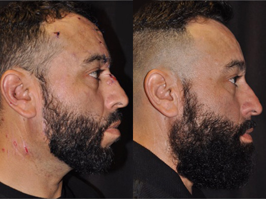 Rhinoplasty before and after 4
