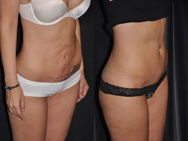 Modified Tummy Tuck with Vertical Incision