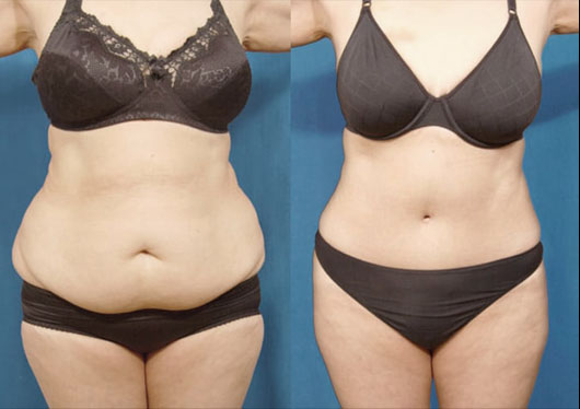 Tummy Tuck before and after patient 2