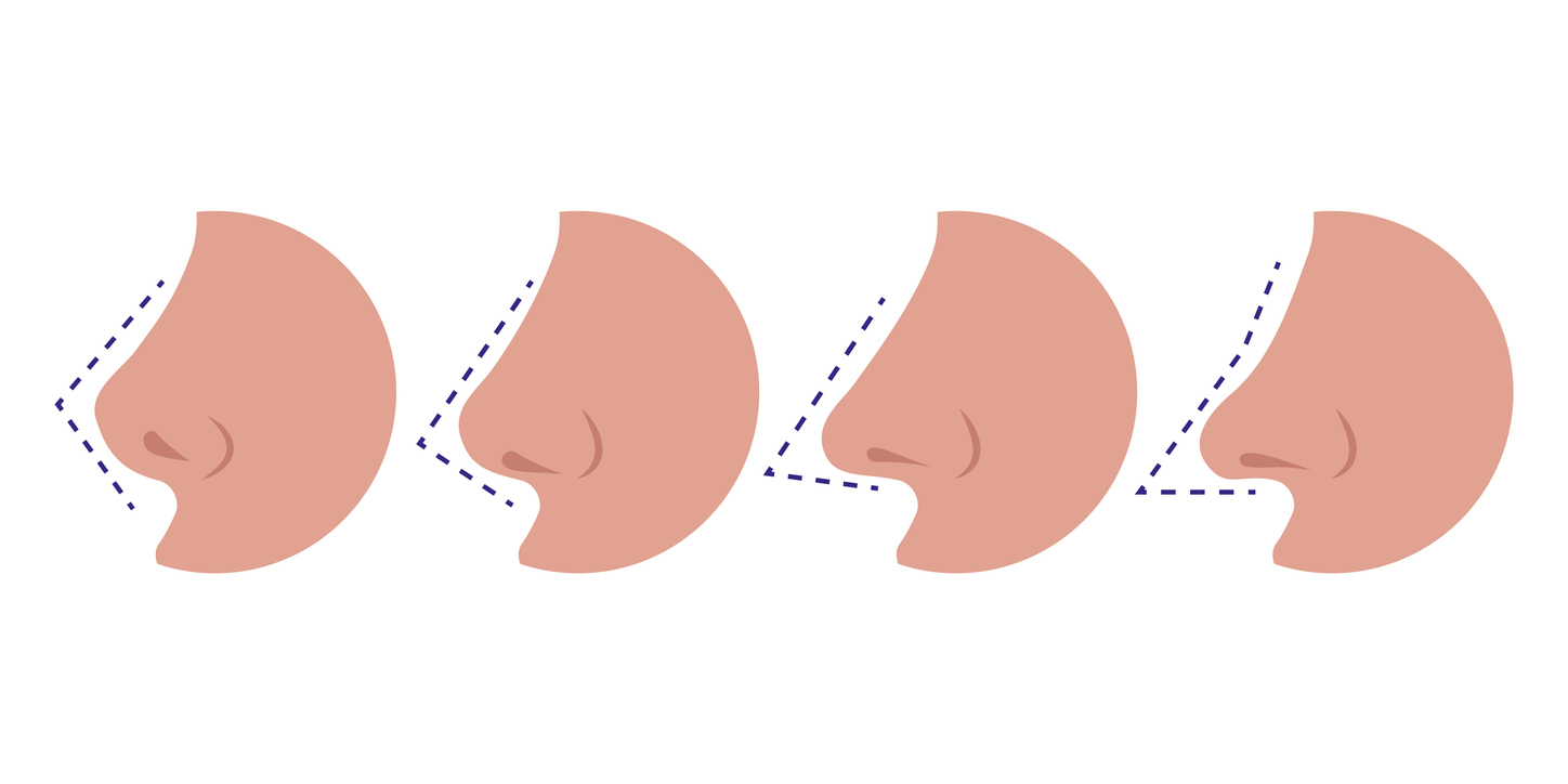 The illustration shows four different nose shapes to explain that there are also many different types of nose jobs.